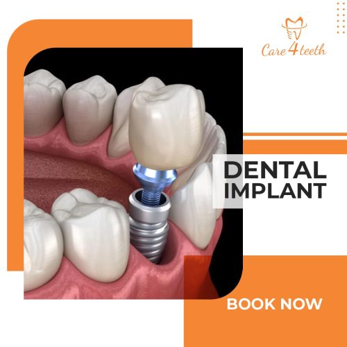 Dental Implant